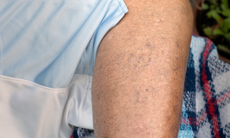 Spider Veins Oneonta