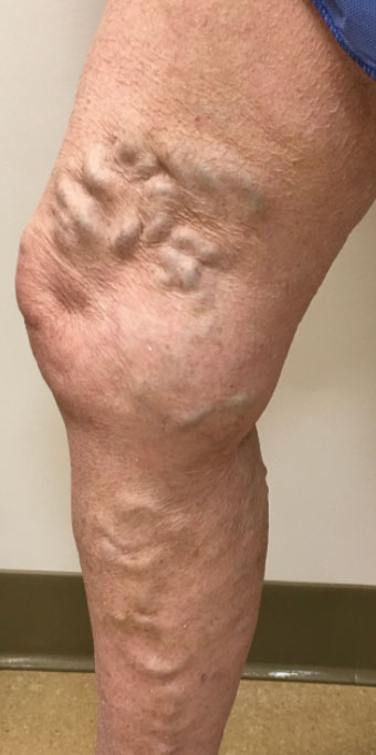 Varicose Veins Binghamton