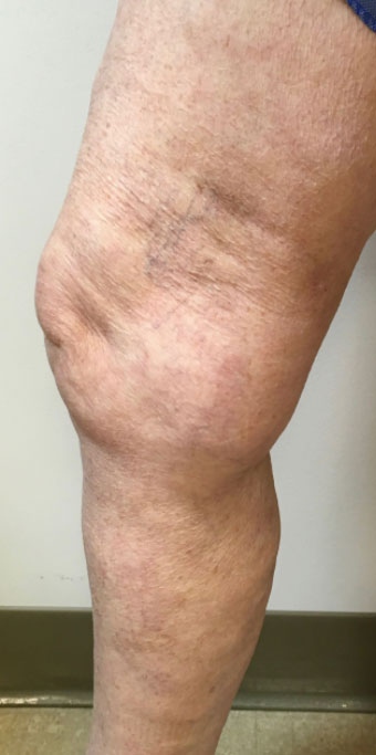 Varicose Veins Binghamton