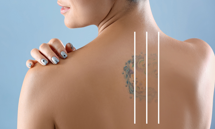 Laser Tattoo Removal Oneonta