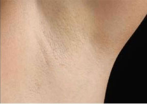 Laser Hair Removal Binghamton