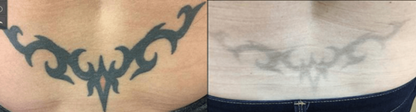 Laser-Tattoo-Removal-Oneonta-600x162