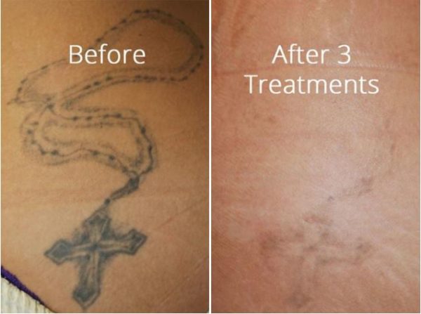 does tattoo removal work well