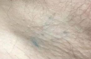 Laser-Tattoo-Removal-Oneonta-NY-After-1