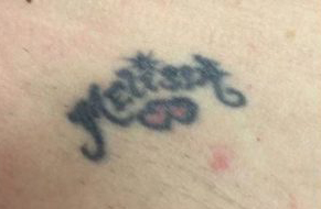 Laser-Tattoo-Removal-Oneonta-NY-Before-1