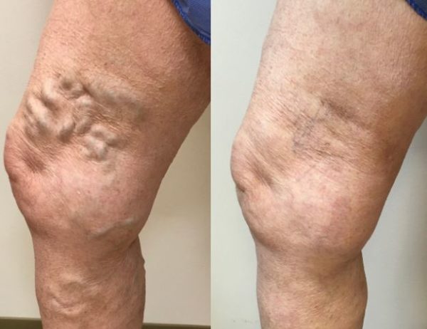 Varicose-Veins-Oneonta-600x462