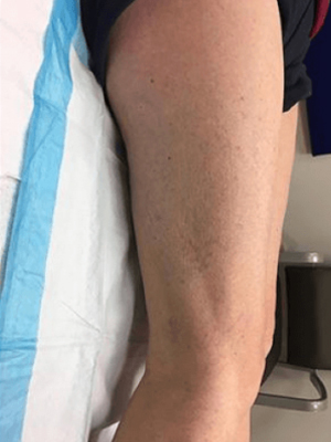 Varicose-Veins-Oneonta-After-2