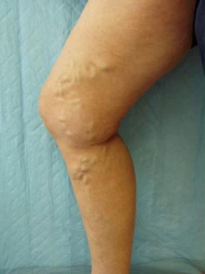 Varicose-Veins-Oneonta-Before-1