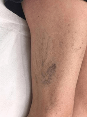 Varicose-Veins-Oneonta-Before-2