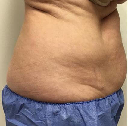 Non-Invasive Body Contouring Binghamton