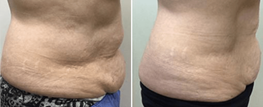 coolsculpting-oneonta