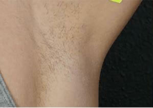 Laser Hair Removal Binghamton