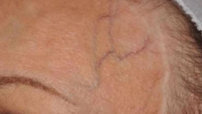 Non-Surgical Skin Rejuvenation Binghamton