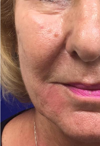 Dermal Fillers Binghamton