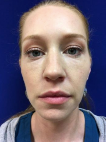 Dermal Fillers Binghamton