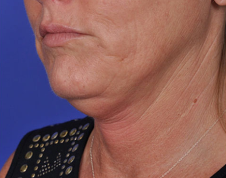 Neck Rejuvenation Binghamton