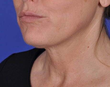 Neck Rejuvenation Binghamton