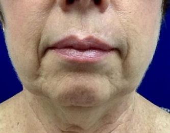 Neck Rejuvenation Binghamton