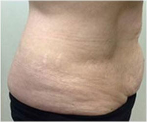 Non-Invasive Body Contouring Binghamton