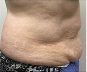 Non-Invasive Body Contouring Binghamton