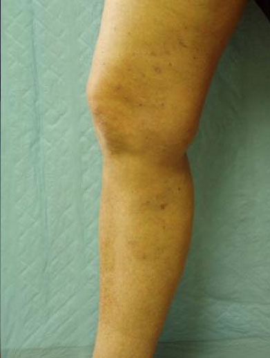 Varicose Veins Binghamton