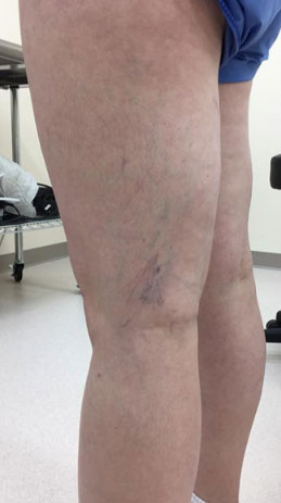 Spider Vein Treatment Binghamton