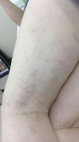 Spider Vein Treatment Binghamton