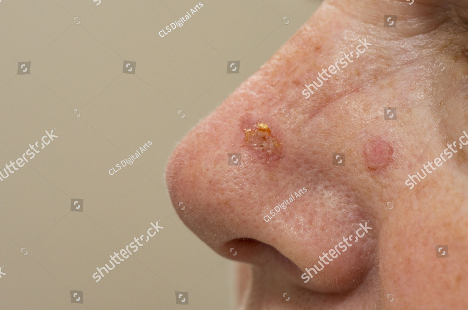 Sunspots On A Nose That Have Been Treated With Cryosurgery 441847699