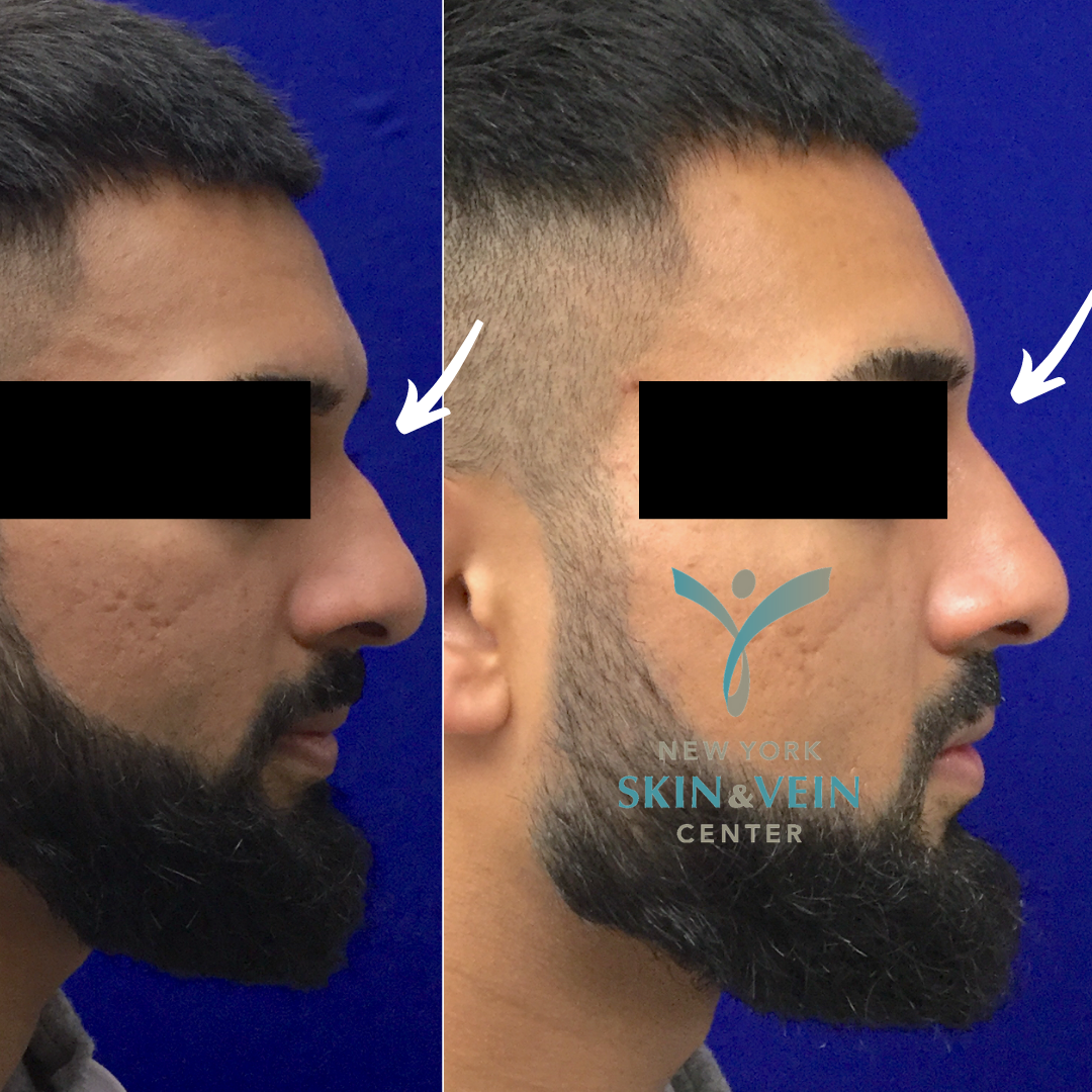 Non surgical rhinoplasty with Restylane