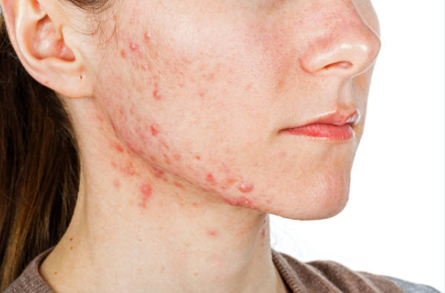 Acne Scars Oneonta