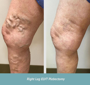 varicose veins1