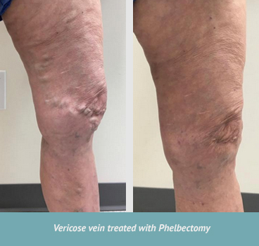 varicose veins7