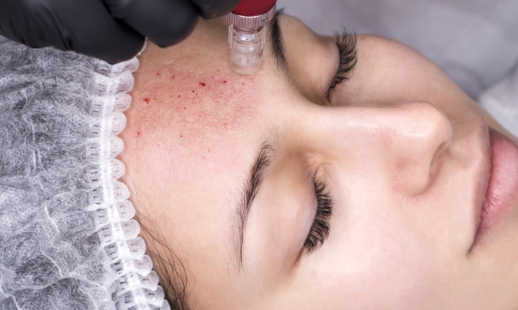 Microneedling Oneonta