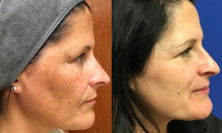 Hyperpigmentation