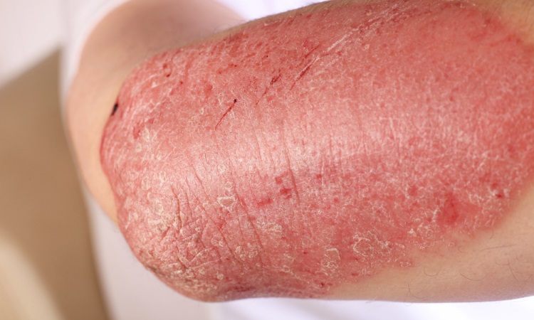 Psoriasis Oneonta