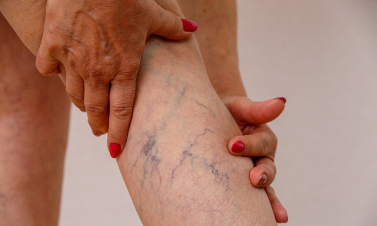Varicose Veins Oneonta