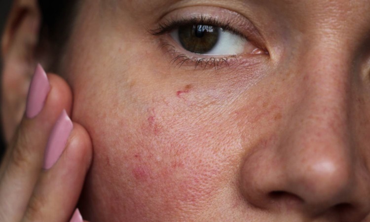 Rosacea Oneonta