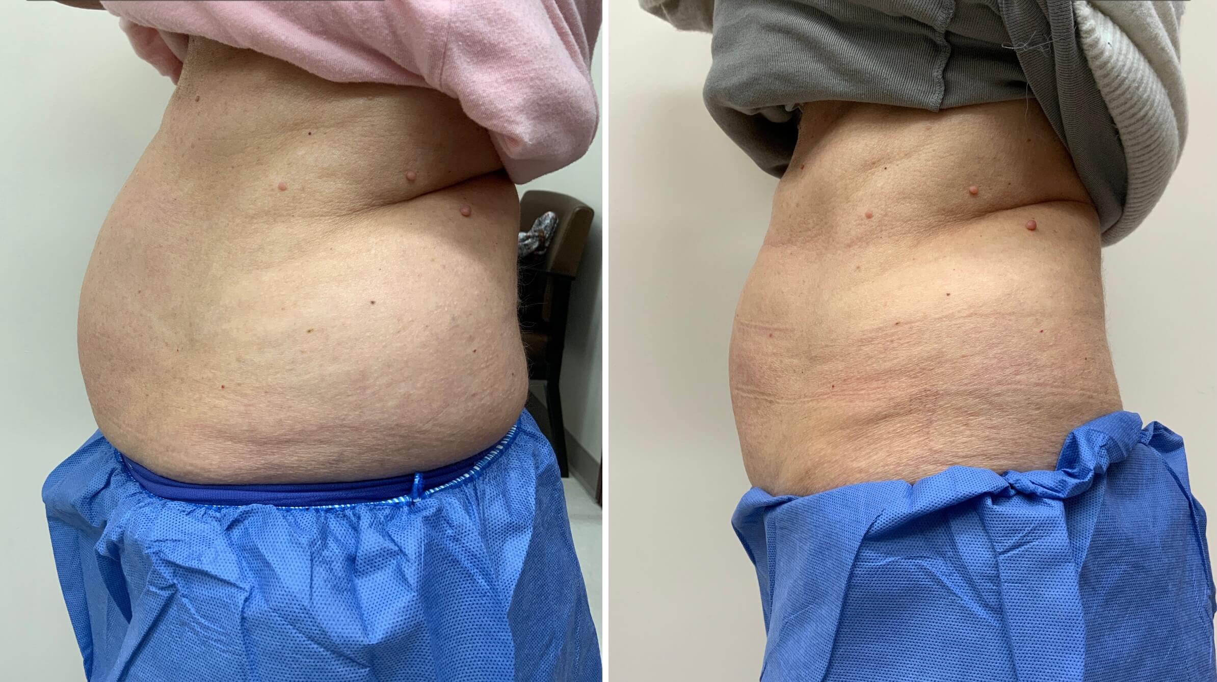 CoolSculpting b&a 2