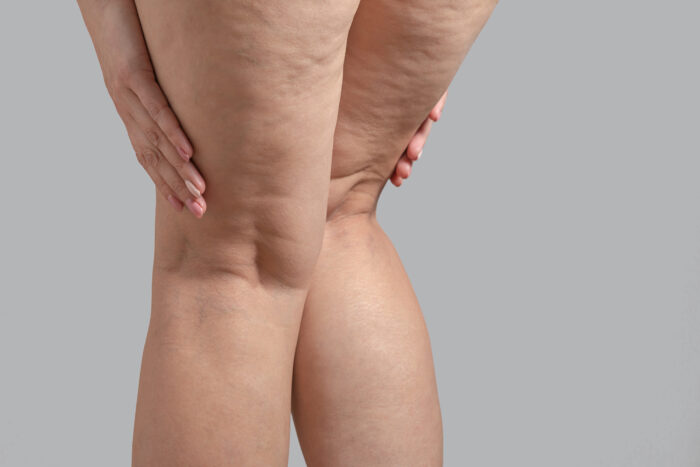 Varicose Veins