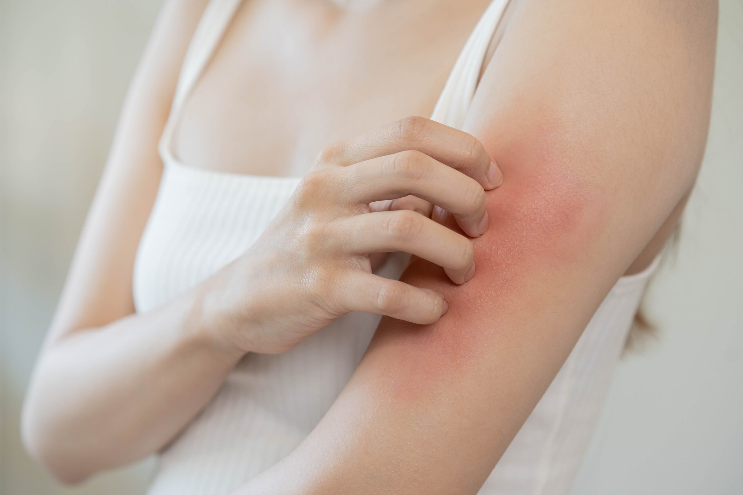 Psoriasis Binghamton, Oneonta, Norwich, Cobleskill