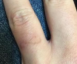 Laser Tattoo Removal Binghamton